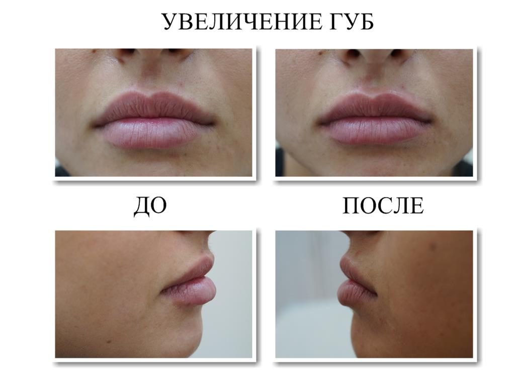 Увеличенные губы. Фото до и после